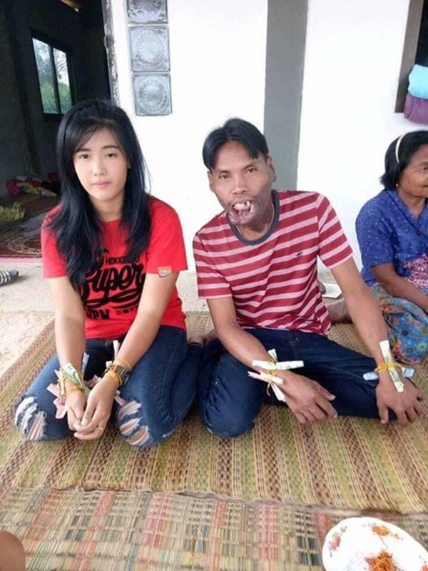 หนุ่มพิการใบหน้า เข้าพิธีผูกข้อมือสาวสวย