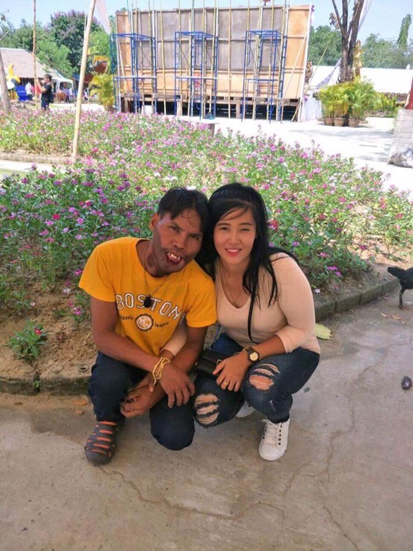 หนุ่มพิการใบหน้า เข้าพิธีผูกข้อมือสาวสวย