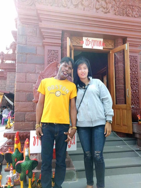 หนุ่มพิการใบหน้า เข้าพิธีผูกข้อมือสาวสวย