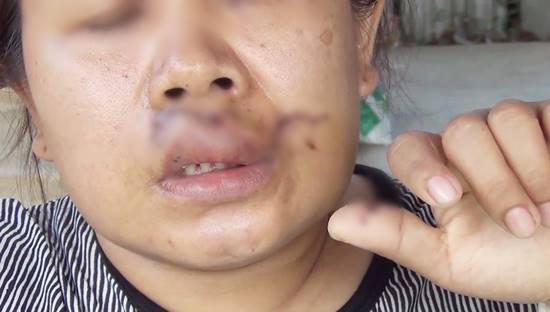 สาวร้องผ่านสื่อ ถูกพิทบูลรุมขย้ำ เย็บ 70 เข็ม ด้านเจ้าของหมาไม่ช่วยสักบาท