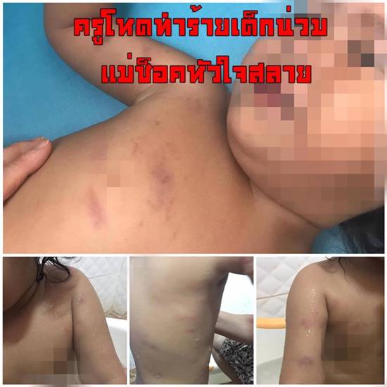 ครูพี่เลี้ยงใจมาร ทุบตีเด็กร่วมชั่วโมงจนช้ำไปทั้งตัว - แม่เศร้าได้รับแค่คำขอโทษ !