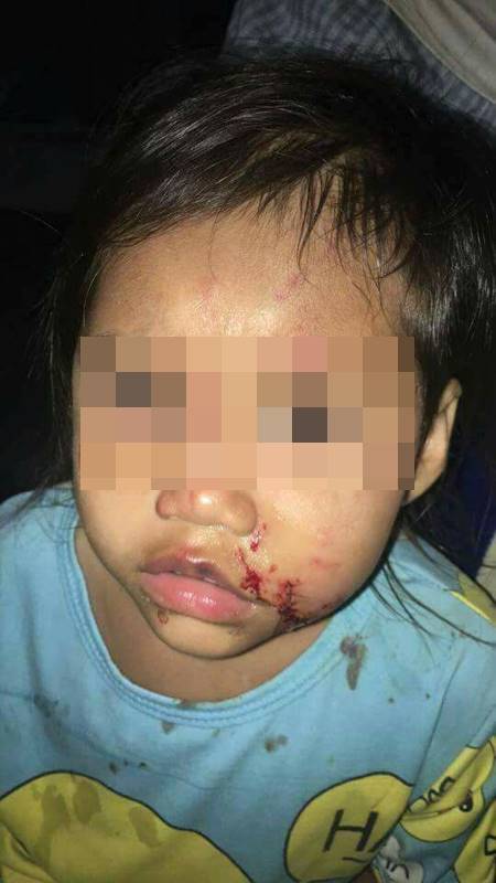 พ่อสุดช้ำ ลูกถูกหมาขย้ำหวิดเสียโฉม แต่เจ้าของตีมึน ซ้ำแจ้งความว่าเด็กกัดหมา