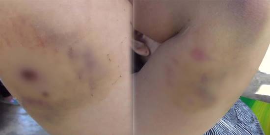 สาวร้องผ่านสื่อ ถูกพิทบูลรุมขย้ำ เย็บ 70 เข็ม ด้านเจ้าของหมาไม่ช่วยสักบาท