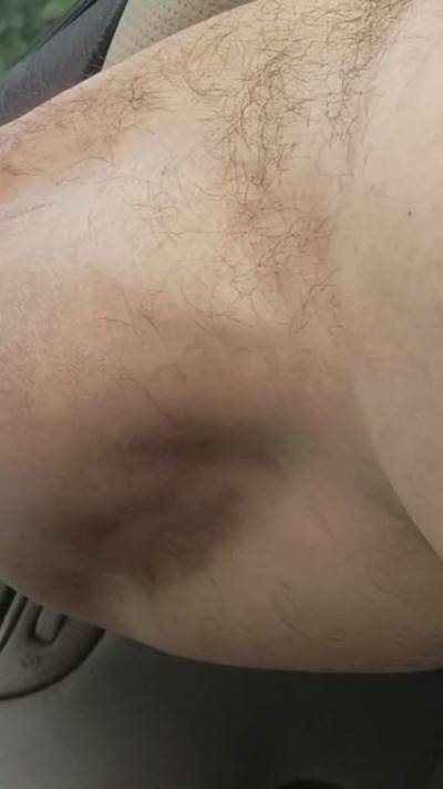 ตะคริวกินขาจนเป็นก้อนดิ้นได้ 