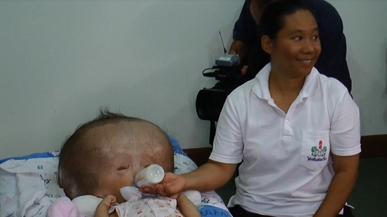 น้องภู เด็กหัวแตงโม