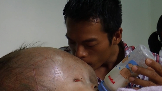 น้องภู เด็กหัวแตงโม