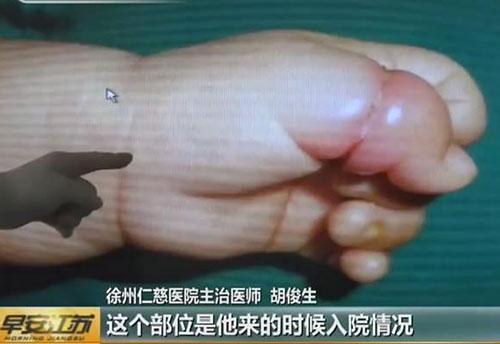 หนูน้อยวัย 2 เดือน หวิดเสียนิ้วโป้ง หลังเส้นผมแม่รัดแน่นจนฝังติดเนื้อ !