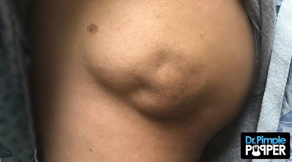 ก้อนซีสต์หน้าเด็ก