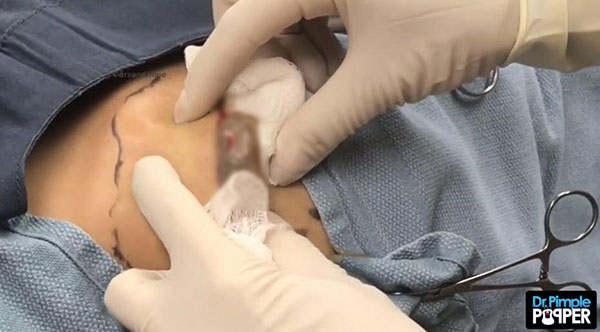 ก้อนซีสต์หน้าเด็ก