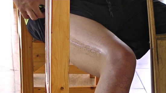 อดีตพลทหารถูกลงโทษขาหัก