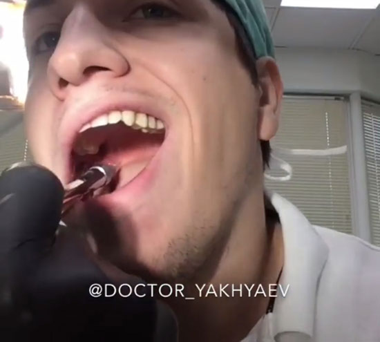 คุณหมอสายโหด โชว์ถอนฟันคุดตัวเองสด ๆ สุดหวาดเสียว เลือดกบปาก