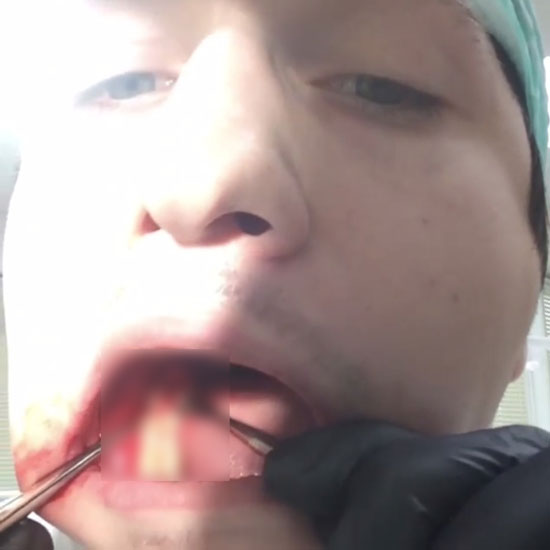 คุณหมอสายโหด โชว์ถอนฟันคุดตัวเองสด ๆ สุดหวาดเสียว เลือดกบปาก