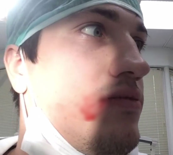 คุณหมอสายโหด โชว์ถอนฟันคุดตัวเองสด ๆ สุดหวาดเสียว เลือดกบปาก