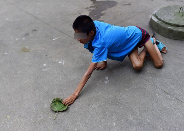 เด็กหนุ่มป่วยสมองพิการ ถูกจับล่ามนาน 10 ปี หลังครอบครัวไม่มีเงินรักษา