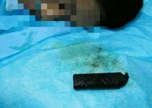 ผงะแรง หมอเจอไฟแช็กในท้องคนไข้ รับกลืนไป 20 ปี ไม่เห็นเคยเป็นอะไร