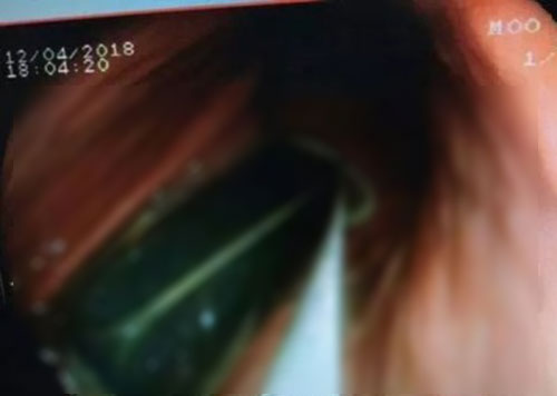 ผงะแรง หมอเจอไฟแช็กในท้องคนไข้ รับกลืนไป 20 ปี ไม่เห็นเคยเป็นอะไร