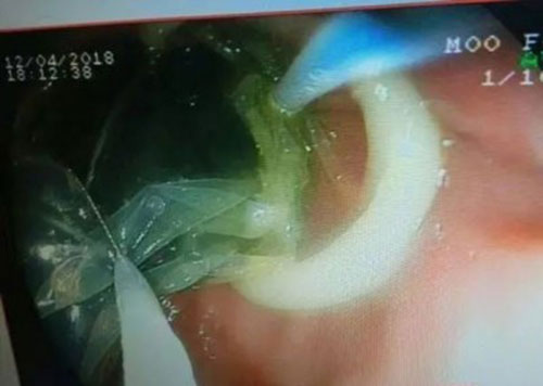 ผงะแรง หมอเจอไฟแช็กในท้องคนไข้ รับกลืนไป 20 ปี ไม่เห็นเคยเป็นอะไร