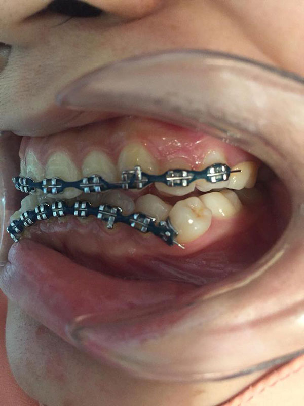 จัดฟันแฟชั่น 100 บาท ทำฟันพังทั้งแถบ