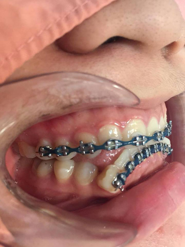 จัดฟันแฟชั่น 100 บาท ทำฟันพังทั้งแถบ