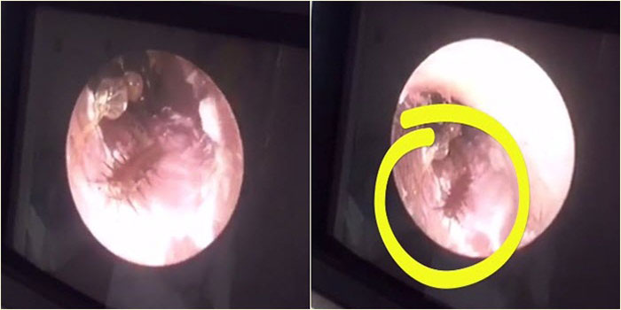 แมลงสาบเข้าหู