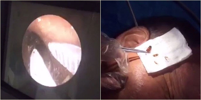 แมลงสาบเข้าหู