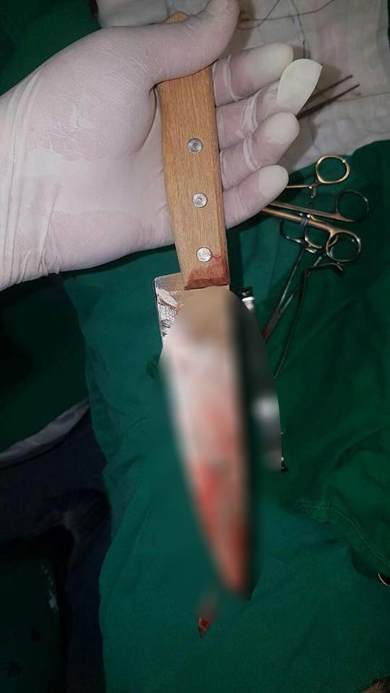 หนุ่มโดนมีดปักกลางหลัง แต่ยังยืนคุยได้อย่างชิล บอกงงไม่รู้มีดมาจากไหน