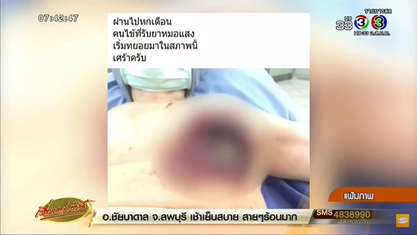 โวยหมอฉกภาพเต้านมผู้ป่วยมะเร็งโดยไม่ขอ - โต้กินยาหมอแสงจนแผลลาม