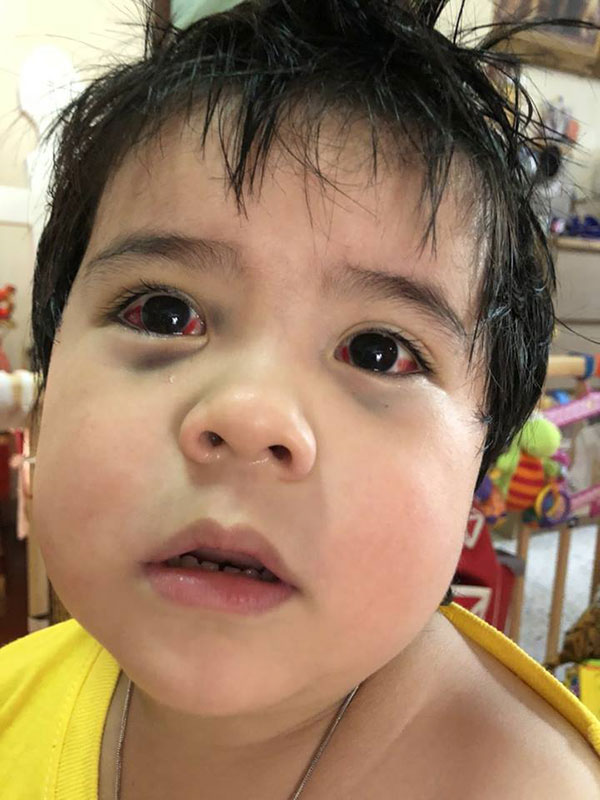 แพทย์ชี้ สาเหตุปมเด็กดูดเสมหะจนตาแตก แนะวิธีดูแล-หายได้ใน 7 วัน