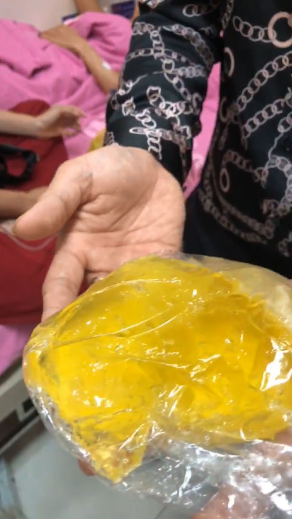 นักร้องสาวช้ำ หน้าอกระเบิดกลางเครื่องบิน เหตุซิลิโคนห่วย-หมอไม่รับผิดชอบ 