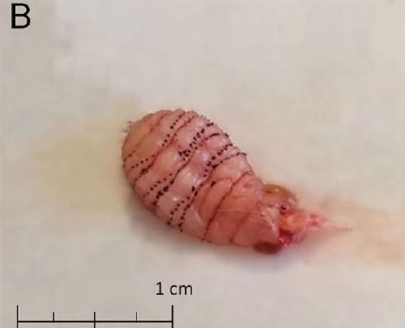 สาวเป็นตุ่มคันที่ขาหนีบ โร่ให้หมอตรวจ แทบกรี๊ดสลบ เจอหนอนใต้เนื้อ