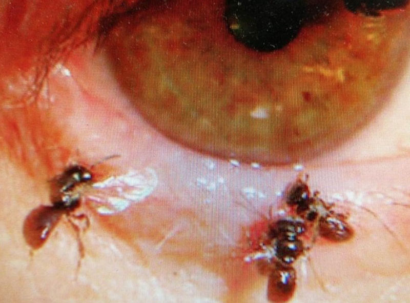 หมอผงะ เจอผึ้ง 4 ตัว ในตาคนไข้หญิง กำลังดูดน้ำตาประหนึ่งดูดน้ำหวาน 