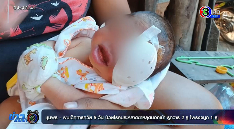 เด็กพิการแต่กำเนิด