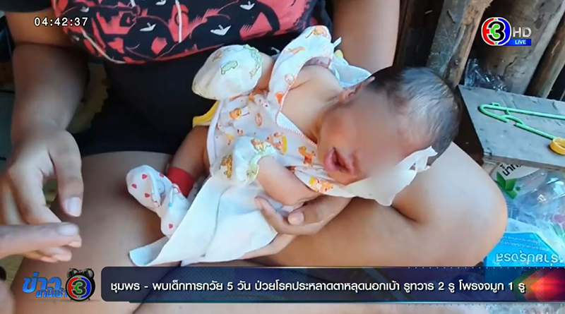 เด็กพิการแต่กำเนิด