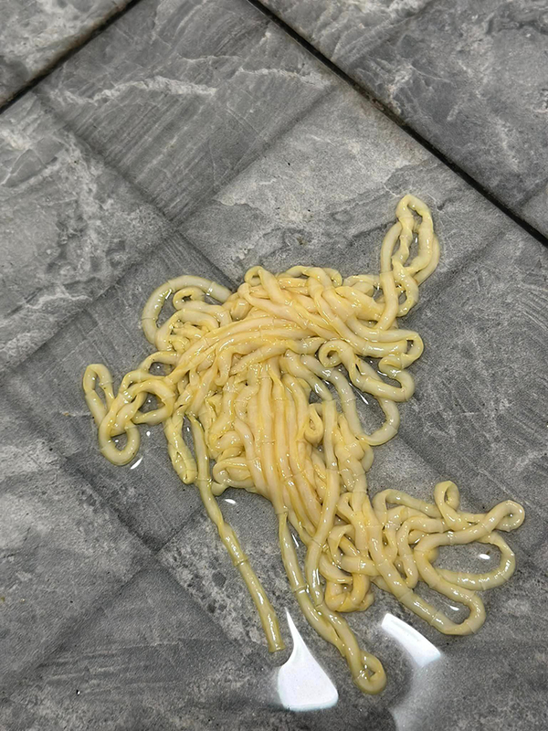 นึกว่าเส้นบะหมี่ ที่แท้พยาธิตืดวัว จากการกินซอยจุ๊