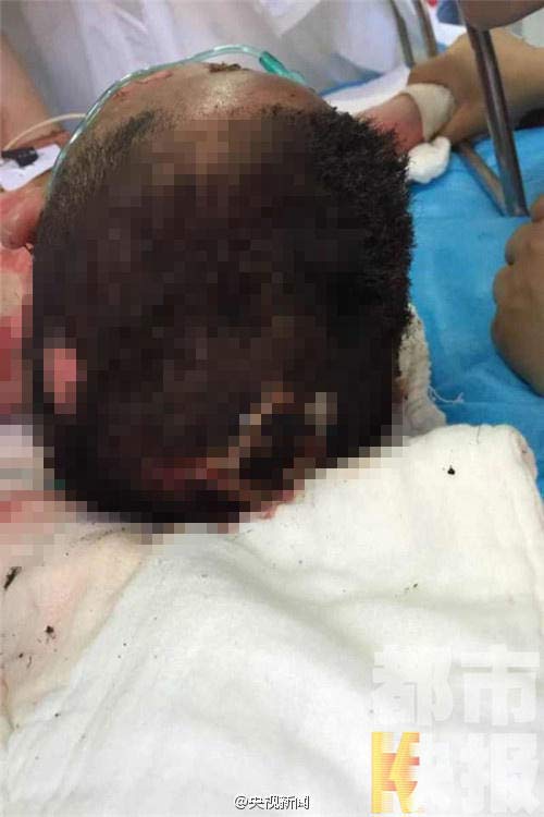 อุทาหรณ์ เด็ก 7 ขวบเกือบตาย เจอไฟดูดสาหัสเพราะฉี่ไม่ดูที่ดูทาง