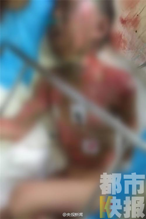 อุทาหรณ์ เด็ก 7 ขวบเกือบตาย เจอไฟดูดสาหัสเพราะฉี่ไม่ดูที่ดูทาง