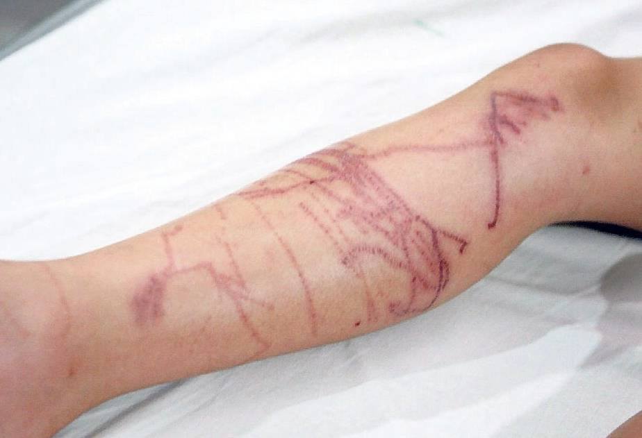 ดร.ธรณ์ แจงสถานการณ์แมงกะพรุนกล่องระบาด แนะวิธีแก้ไขหากโดนพิษ