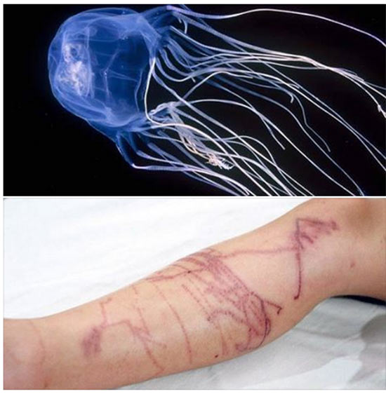 ดร.ธรณ์ แจงสถานการณ์แมงกะพรุนกล่องระบาด แนะวิธีแก้ไขหากโดนพิษ