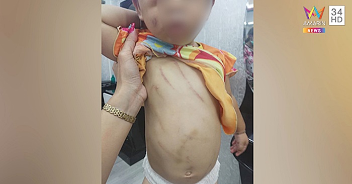  ฝากเลี้ยงลูก กลับมาช้ำทั่วตัว