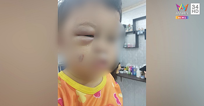  ฝากเลี้ยงลูก กลับมาช้ำทั่วตัว
