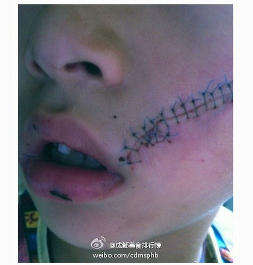 เด็กจีนสุดซวย โค้กกระป๋องระเบิดอัดหน้ายับ เย็บ 38 เข็ม