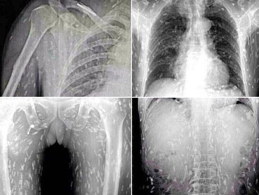 ชายจีนคอปลาดิบสุดช็อก เอกซ์เรย์เจอพยาธิทั่วตัว