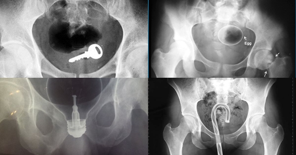 ภาพเอกซเรย์ สารพัดสิ่งของที่เคยหลุดเข้าทวารหนัก