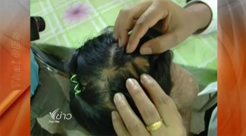 ราดน้ำร้อนเด็กกะเหรี่ยง