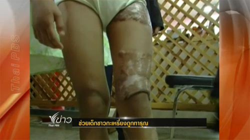 ราดน้ำร้อนเด็กกะเหรี่ยง