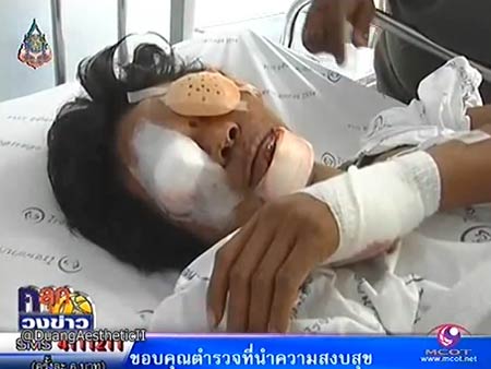 มือถือก๊อปจีนระเบิดใส่หน้าหนุ่มเขมร 