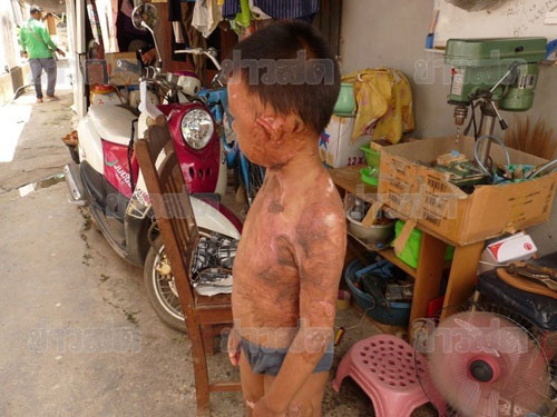 เด็ก 7 ขวบ ตกกระทะทอดปาท่องโก๋ พุพองทั้งตัว