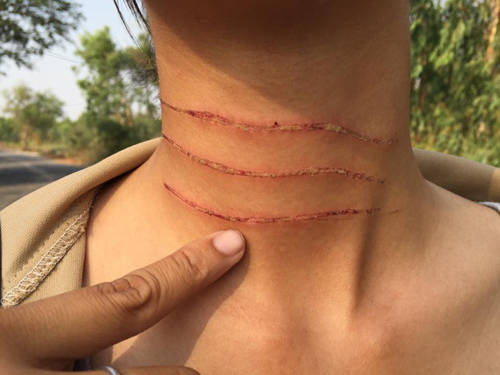 มหาสารคาม ผวา มือมืด ขึงเอ็นปาดคอ โดนไปแล้ว 1 ราย