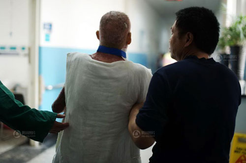 พ่อจีนยอมตัดผิวหนัง ช่วยรักษาลูกสาวถูกไฟไหม้