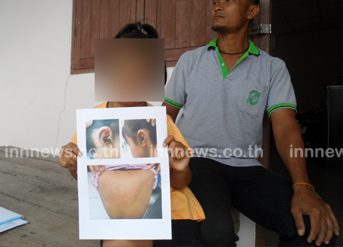 ครูตีเด็ก พ่อแม่โวย ใช้หวายตี มือตบบ้องหูลูกสาววัย 6 ขวบ